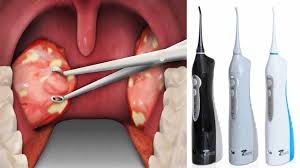 Black And White Spots On Tonsils Pin On Sore Throat Remedies For Adults