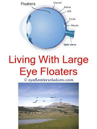 Eye Floaters And Flashes Youtube Eye Floaters Bright Light Curing Floaters In The Eyes Naturally Floaters Cause Eye Dry Eyes Dry Eyes Causes Dry Eyes Relief