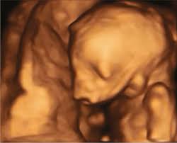 Maybe you would like to learn more about one of these? Diagnosis Of Fetal Syndromes By Three And Four Dimensional Ultrasound Is There Any Improvement