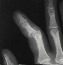 Image result for Lateral PIP Dislocation