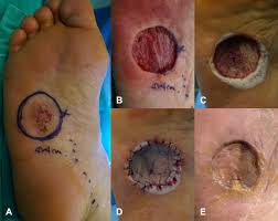 Arising from melanocytes, melanoma can look like a mole and some develop within an existing mole. Skin Graft Using Matriderm For Plantar Defects After Excision Of Cmar