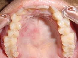 Image result for oral herpes symptoms roof of the mouth
