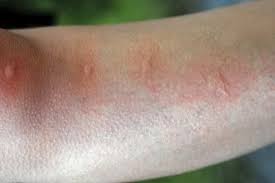 Flea Bites That Look Like Mosquito Bites 8 Bug Bites That Blister Bug Bites That Blister Itchy Bug Bites Bug Bites