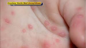 Hand foot and mouth pictures. Hand Foot And Mouth Disease Outbreak At Princeton University 6abc Philadelphia