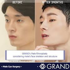 Gradn Plastic Surgery Helps To Upgrade Our Customers Into Better Looking Guys For Free Consultation Tel 82 70 7119 Plastic Surgery Eye Surgery Surgery