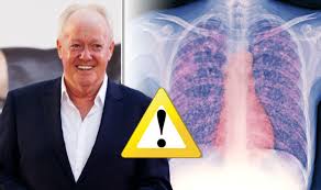 He also had a … Keith Chegwin Dead Lung Condition Idiopathic Pulmonary Fibrosis Explained Express Co Uk