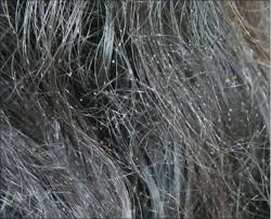No dying your hair does not get rid of white piedra.i have now had it for years and have to be careful how i treat my hair as it breaks so easily with this. Indian Journal Of Dermatology Venereology And Leprology Trichosporon Inkin And Trichosporon Mucoides As Unusual Causes Of White Piedra Of Scalp Hair