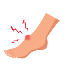 75% of americans will experience foot problems at one time or another in their lives. Foot Contusion Upswing Health