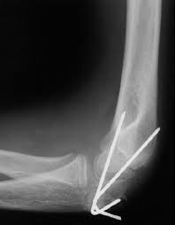Some patients heal faster, some slower. Elbow Fractures In Children Orthoinfo Aaos