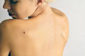 Exercise care in patients with history of slow healing or skin infection. Moles Lumps And Bumps On Skin And Face Skintour