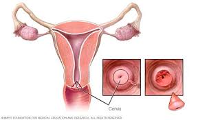 Tests that help evaluate cervical cancer. Cervical Cancer Diagnosis And Treatment Mayo Clinic