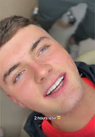 Transforming Smiles with Composite Veneers in Belfast