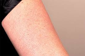 10 Ways To Get Rid Of Those Stubborn Bumps On The Back Of Your Skin Bumps Dry Skin Bumps Keratosis Pilaris