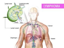 What is lymphoma of the skin? Overview Of Non Hodgkins Lymphoma Cancerconnect