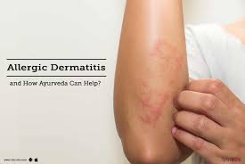 This usually happens when a. How Ayurveda Can Help In Allergic Dermatitis Treatment By Dr Manoj Virmani Lybrate
