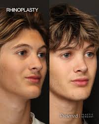 A year after his rhinoplasty, his profile shows how powerful subtle changes  can be. The goal wasn't to change his look — just to refine it. 👃✨ Cast  comes off around day