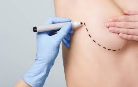 Image result for Mastectomy