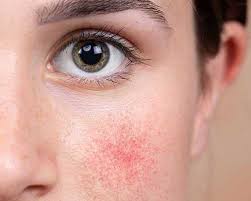 Treatment was fast, easy, painless and explained well. Dfw Laser Aesthetics Dfw Laser Aesthetics Offers The Latest In Skin Care Technology In The Dallas Fort Worth Surrounding Areas