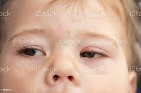 Gozun Ust Goz Kapagi Uzerinde Beyaz Sivilce Milyum Kucuk Bir Bebek Cocugun Goz Iltihabi Konjonktivit Milium Cilt Yumusak Odak Uzerinde Olusan Kucuk Sert Soluk Keratiye Nodulu Oldugunu Stok Fotograflar Akne Nin Daha