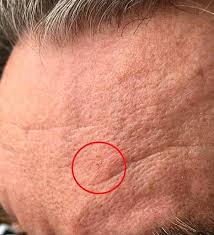 19.08.2011 · a form of keratosis that is considered precancerous is actinic keratosis. Quite An Inconspicuous Skin Change Can Lead To Cancer This Is What Solar Keratosis Can Look Like Teller Report