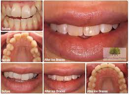 For people undergoing orthodontic treatment, food lodgement and metal appliances may so, if you are wearing braces then methods to whiten teeth include whitening toothpaste, home bleaching, and office bleaching. Invisible Braces Cardiff Birchgrove Dental Practice