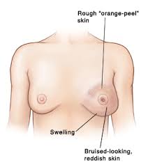 Due to the inflammatory nature of this particular cancer, your breast may look and feel different. Inflammatory Breast Cancer Saint Luke S Health System