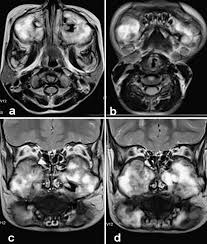 On radiography, the lesions exhibit bilateral multinuclear radiolucent areas. Radiographic Ct And Mri Features Of Cherubism Springerlink