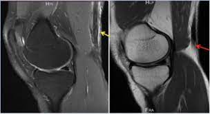 Leider ist das süße gebäude aber nicht ganz so gelungen, wie es sich die frau von peer kusmagk vorgestellt hat. Investigation And Management Of An Isolated Complete Distal Avulsion Of Semitendinosus Bmj Case Reports