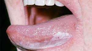 But remember to take this process one step at a time. Tongue Cancer Symptoms Pictures Prognosis
