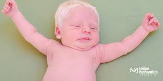 Skin cancer is another risk, particularly to those who burn their skin severely enough that sunburn blisters occur. People With Albinism At High Risk For Skin Cancer