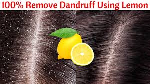 Both aloe vera and lemon have anti fungal and anti bacterial properties that helps treat dandruff really fast. How To Use Lemon To Remove Dandruff In Just 1 Day Get Rid Of Dandruff Permanently 100 Effective Youtube