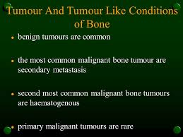 • is the most common primary bone cancer. Tumour And Tumour Like Conditions Of Bone L Benign Tumours Are Common L The Most Common Malignant Bone Tumour Are Secondary Metastasis L Second Most Common Ppt Download