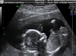 Ultrasonido Genetico Entre La Semana 11 Y La Semana 13 Con 6 Dias