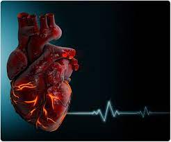 Pericarditis is inflammation of the pericardium (the fibrous sac surrounding the heart). Pericardite Di Ricorso