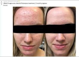 Fungal Acne What Is It Have You Got It How To Get Rid Back Acne Treatment Diy Acne Treatment Acne Treatment