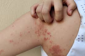 Image result for Impetigo