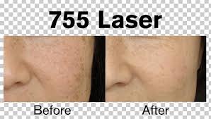 National board certified permanent cosmetic instructor, artist, medical electrology in tampa bay. Eyebrow Laser Hair Removal Skin Arm Png Clipart Alexandrite Arm Before And After Cheek Chin Free
