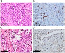 Ihc revealed loss of bap1 nuclear staining in 47 of these 70. Utility Of Survivin Bap1 And Ki 67 Immunohistochemistry In Distinguishing Epithelioid Mesothelioma From Reactive Mesothelial Hyperplasia