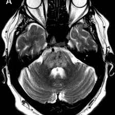 Mri is the imaging modality of choice for the assessment of patients with suspected brainstem the appearance of clippers on mri is fairly unique, characterized by multiple punctate, patchy and. Clippers With Brain And Spinal Cord Involvement Eurorad