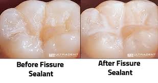Tool the sealant immediately after application. Sealants