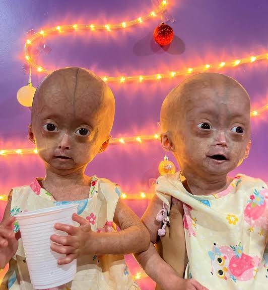 Gêmeas com síndrome do envelhecimento passam primeiro Natal com diagnóstico  da condição: 'ano de conquistas para elas' | G1