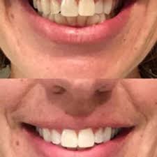 Check spelling or type a new query. Smiledirectclub Customer Reviews Before After Smiledirect Treatment Smile Prep