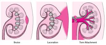 That there is no exit arteriole as all of the blood flow is changed to filtrate. Kidney Injuries Injuries And Poisoning Merck Manuals Consumer Version