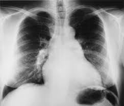 Pleuropulmonary Manifestations Of Systemic Lupus Erythematosus Thorax
