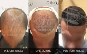Se stai cercando un rimedio definitivo alla calvizie, sei nel posto giusto: Trapianto Capelli Turchia All Inclusive Al Migliore Prezzo E Qualita Top