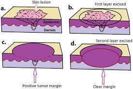 Negative, not involved, clear, or free margins mean that no cancer cells are found at the outer edge. Mohs Micrographic Surgery Intechopen