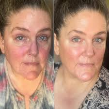 Check out Cindy's results + story🥰👇 “I just wanted to share a photo  testimonial of my first week using these products. I began my skincare  journey four years ago and had wonderful