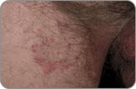 Detailed dosage guidelines and administration information for lamisil at jock itch (terbinafine hydrochloride). What Is Jock Itch What Causes Jock Itch Lotrimin