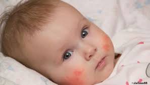 These bumps may appear red, especially in babies with light skin as mentioned earlier, most cases of skin rash in babies tend to disappear on their own within a few days. A New Mom S Guide To Baby Rashes Triad Moms On Main Greensboro Winston Burlington High Point