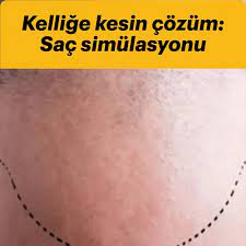 Sac Dokulmesinde Yeni Tedavi Yontemi Sac Simulasyonu Sac Guzellik Sac Dokulmesi